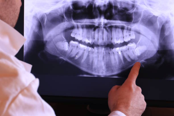 Best Emergency Tooth Extraction in Loyola, CA
